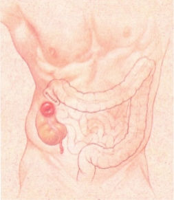 Ostomi Nedir Ostomi Nedir