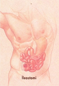 Ostomi Nedir
